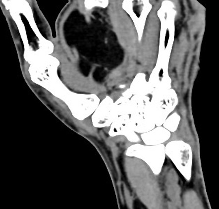 Intramuscular lipoma - hand | Image | Radiopaedia.org