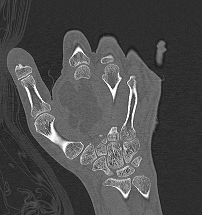 Intramuscular lipoma - hand | Image | Radiopaedia.org