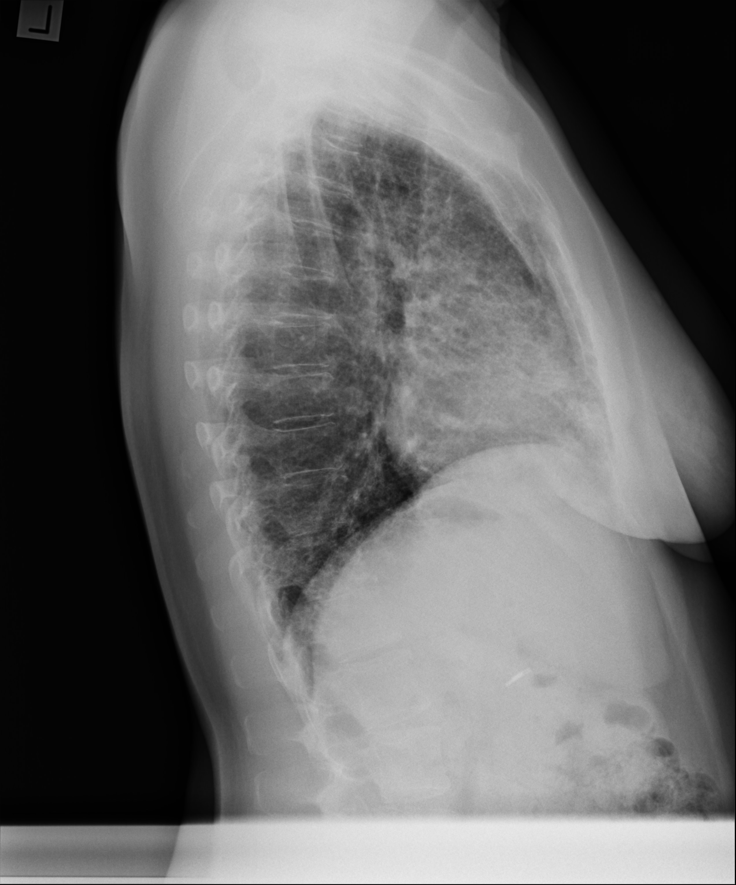 Usual interstitial pneumonia | Image | Radiopaedia.org