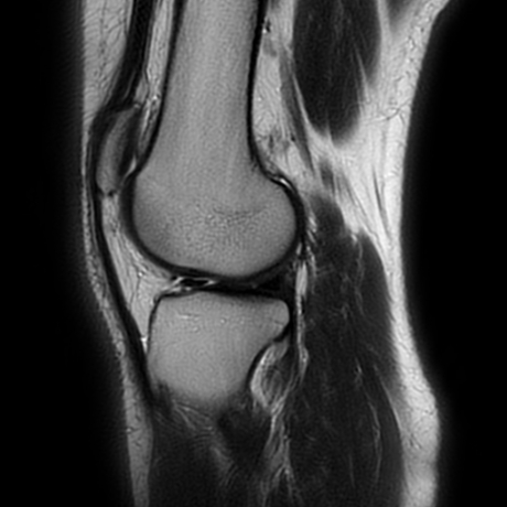 Hoffa Fat Pad Impingement Syndrome 