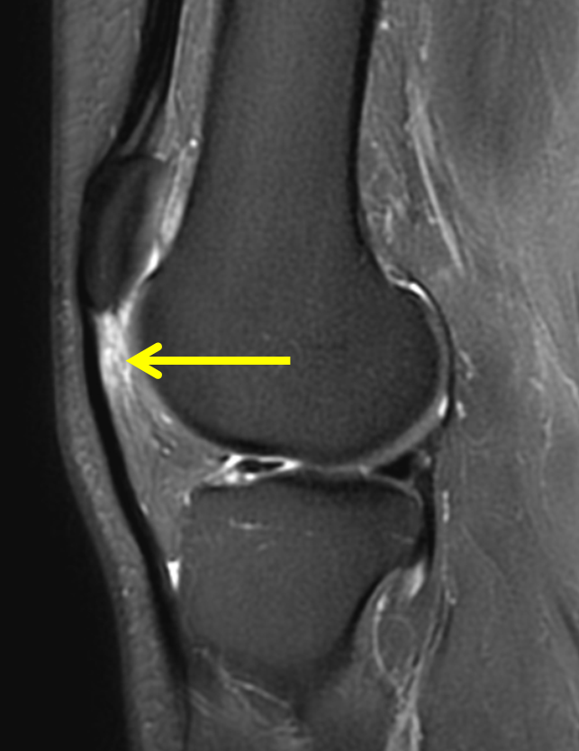 Hoffa Syndrome Fat Pad Impingement Princeton Orthopae - vrogue.co