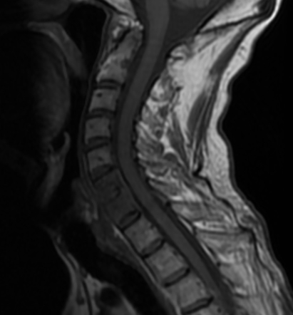 OS Trigonum MRI