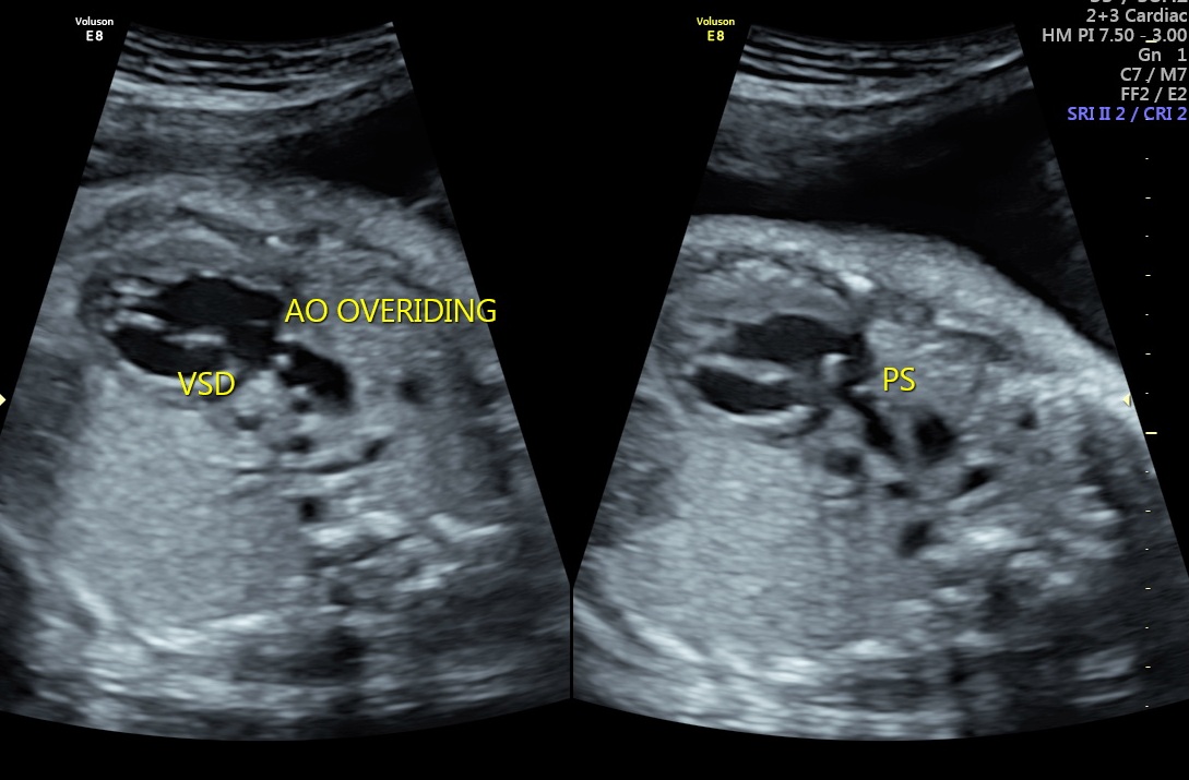 Tetralogy of Fallot with pulmonary stenosis - antenatal | Image ...