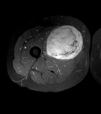 Soft tissue sarcoma | Radiology Reference Article | Radiopaedia.org