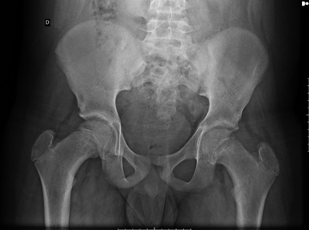 Slipped upper femoral epiphysis | Image | Radiopaedia.org