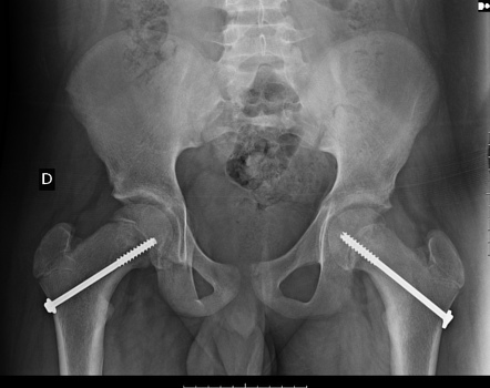 Cannulated screws | Radiology Reference Article | Radiopaedia.org