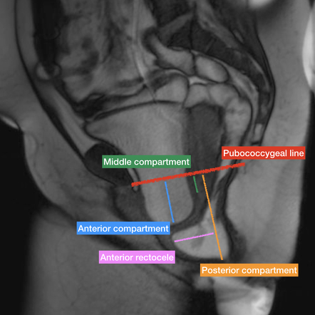 Pelvic Floor Dysfunction/Prolapse