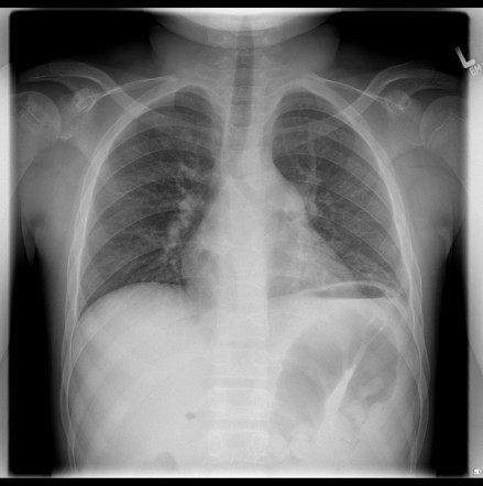 Acute chest syndrome - sickle cell disease | Radiology Case ...