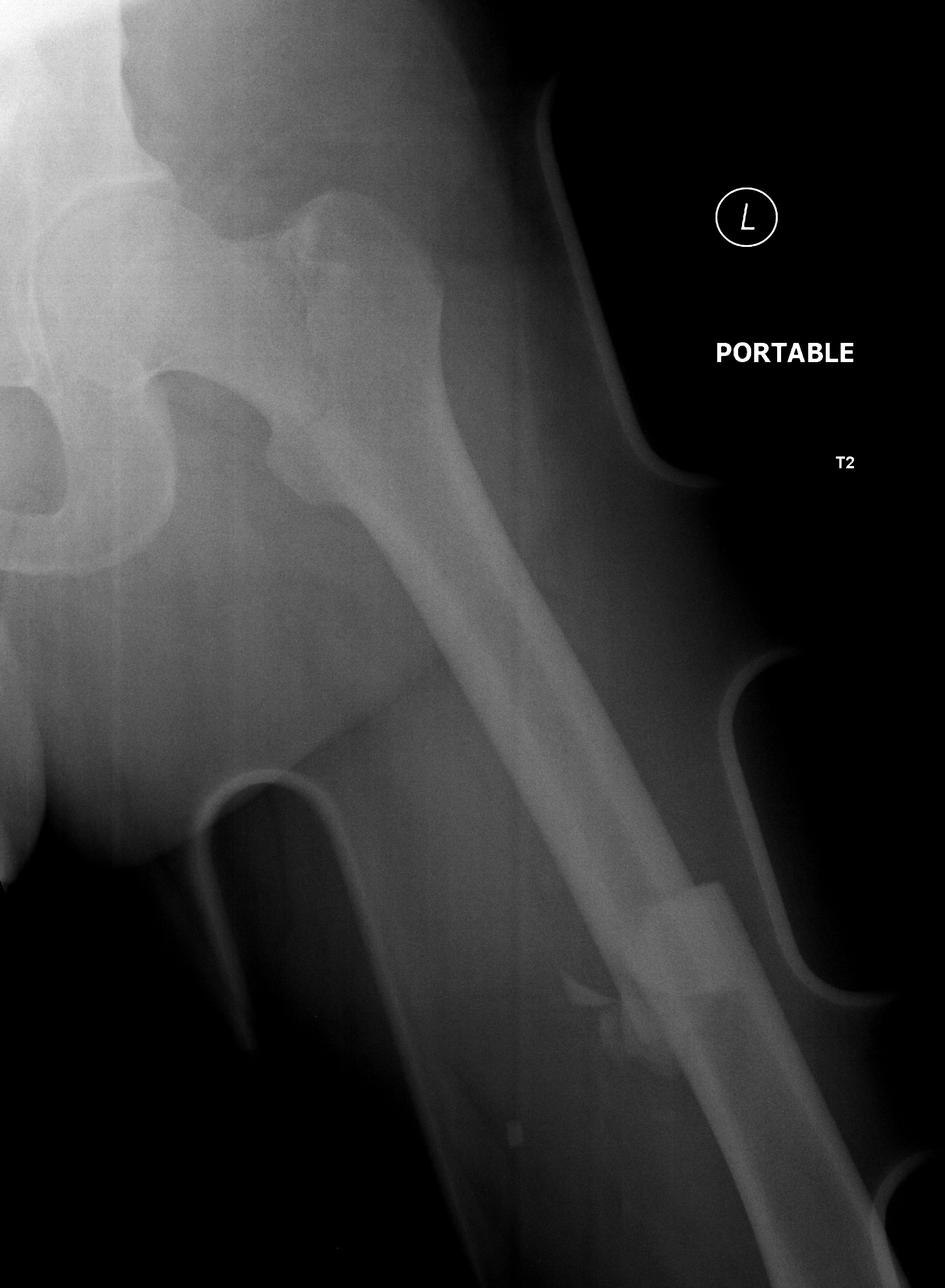 Intertrochanteric fracture | Image | Radiopaedia.org