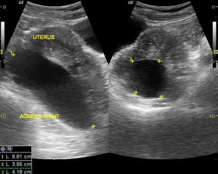 Linear Ultrasound Hydrosalpinx