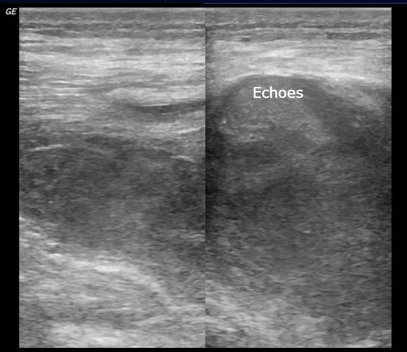 Post Injection Gluteal Hematoma 