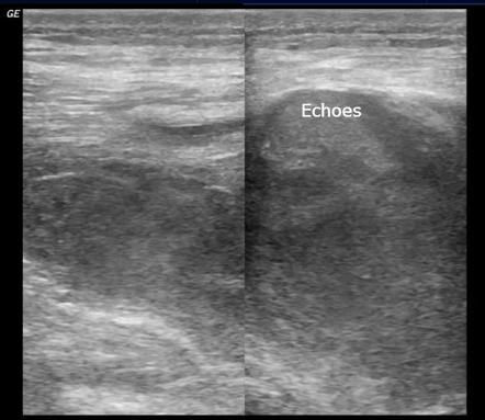 Post injection gluteal hematoma | Image | Radiopaedia.org