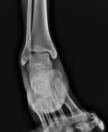 Tarsal navicular fracture | Radiology Case | Radiopaedia.org