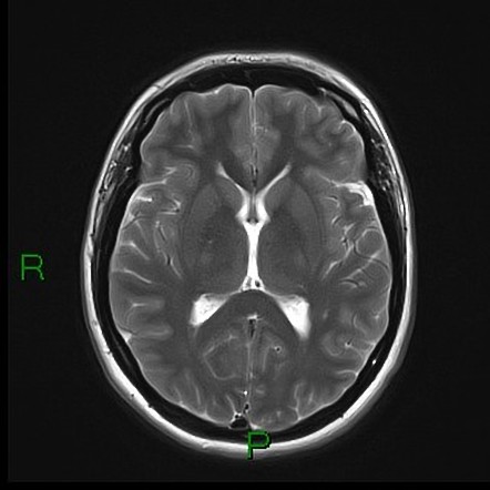 Imaging Of Medulloblastoma Neupsy Key