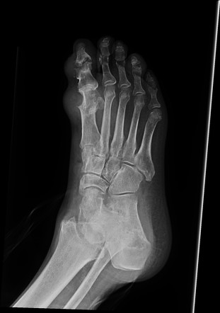 Gout arthropathy | Image | Radiopaedia.org