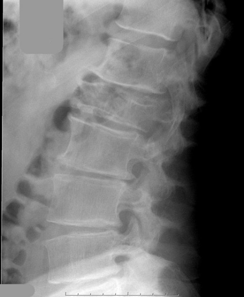 Pathological vertebral crush fracture: plasmacytoma | Image ...