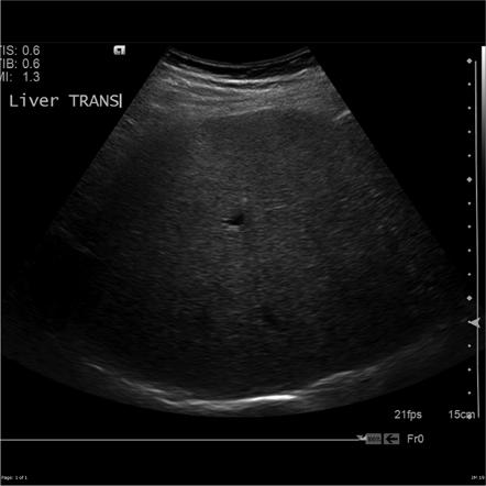 Hepatocellular carcinoma developing in a cirrhotic liver | Radiology ...