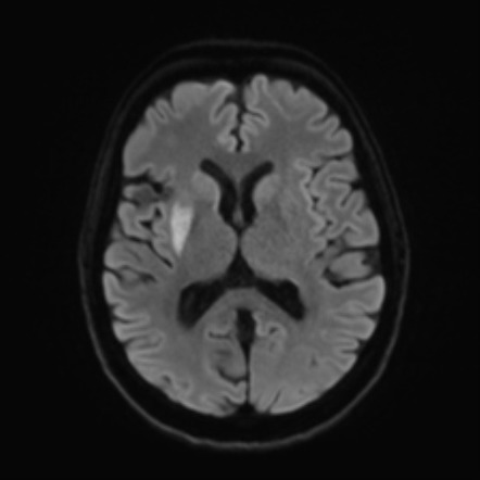 Striatocapsular infarct | Radiology Reference Article | Radiopaedia.org