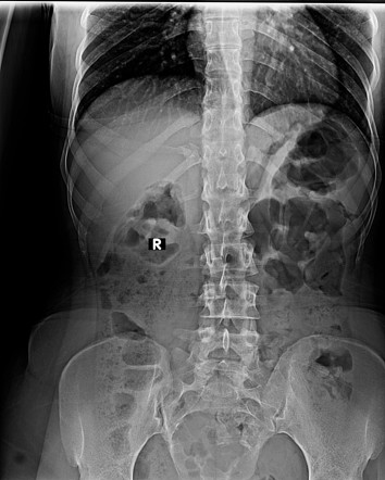 Sacrococcygeal chordoma | Image | Radiopaedia.org