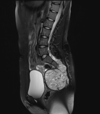 Sacrococcygeal chordoma | Image | Radiopaedia.org