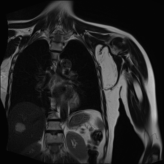 Axillary lipoma | Image | Radiopaedia.org