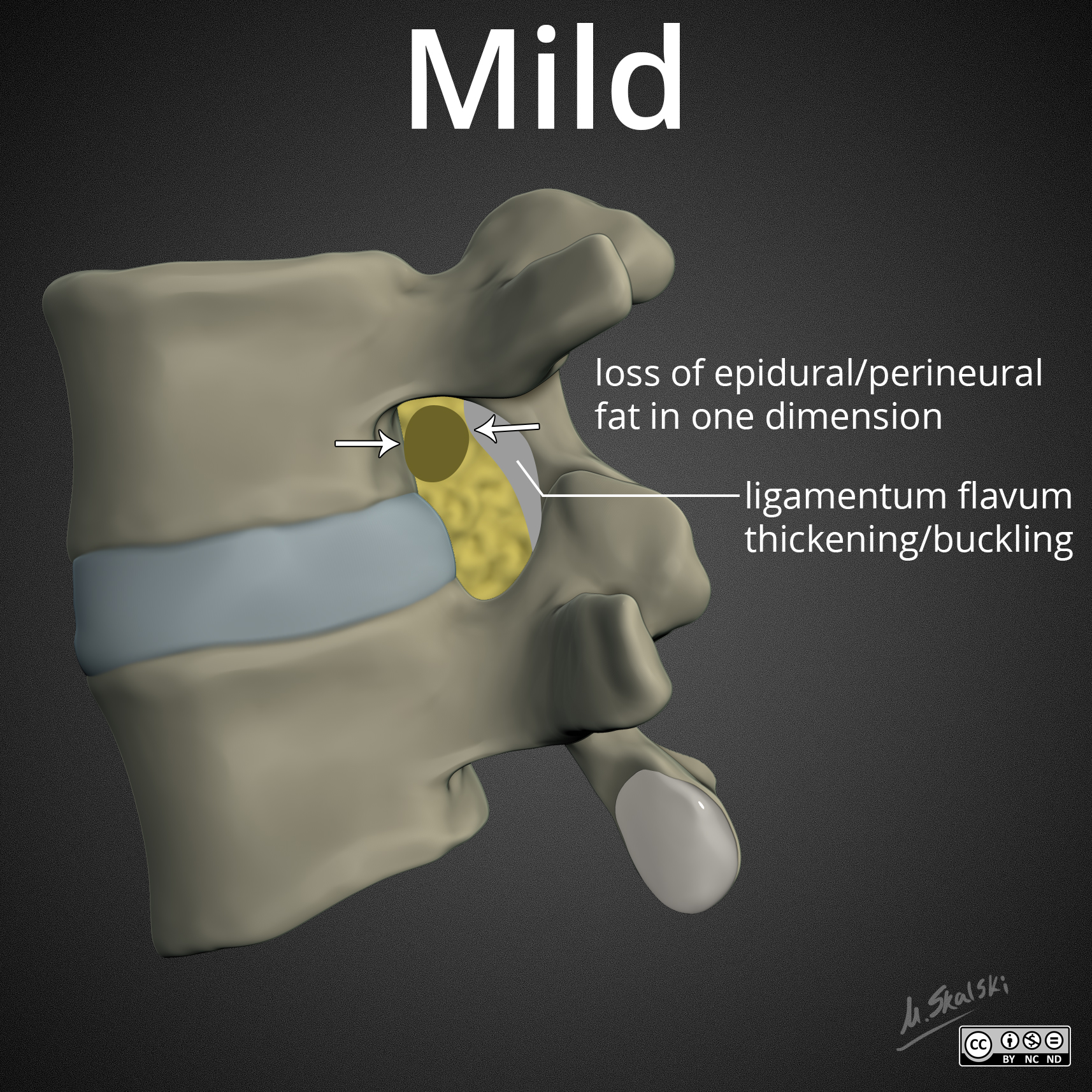 Lumbar Neuroforaminal Stenosis - Illustrations | Image | Radiopaedia.org