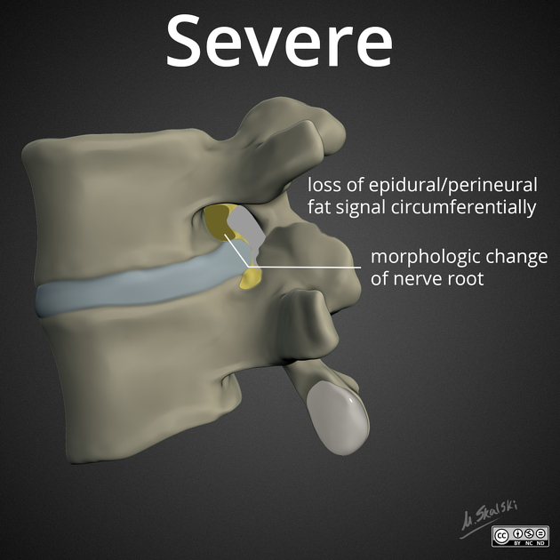 Grade of nerve root compression.