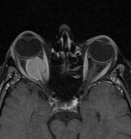 Optic Nerve Meningioma Mri