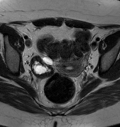 Broad ligament leiomyoma | Radiology Case | Radiopaedia.org