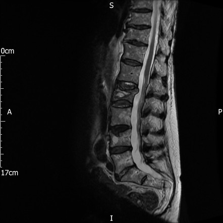 Osteoporotic fracture | Image | Radiopaedia.org