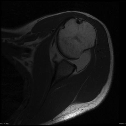 Glenoid labral avulsion | Radiology Case | Radiopaedia.org