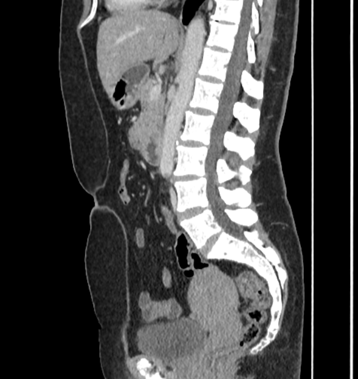 Duodenal adenocarcinoma | Image | Radiopaedia.org