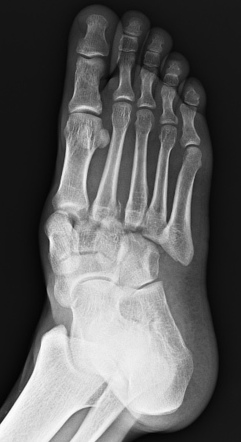 Lisfranc fracture, Myerson type A | Image | Radiopaedia.org