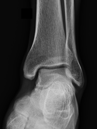 Lisfranc fracture, Myerson type A | Image | Radiopaedia.org