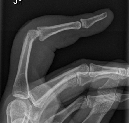 Osteomyelitis | Radiology Reference Article | Radiopaedia.org