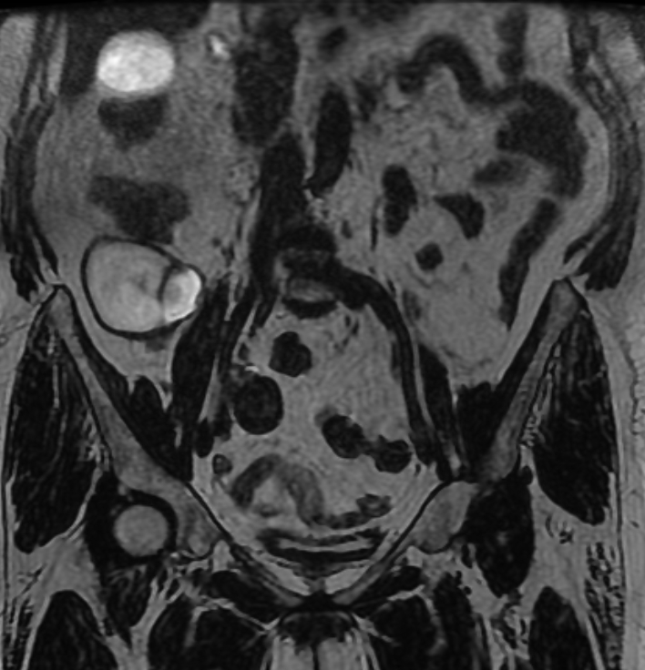 Low Grade Appendiceal Mucinous Neoplasm Lamn Image