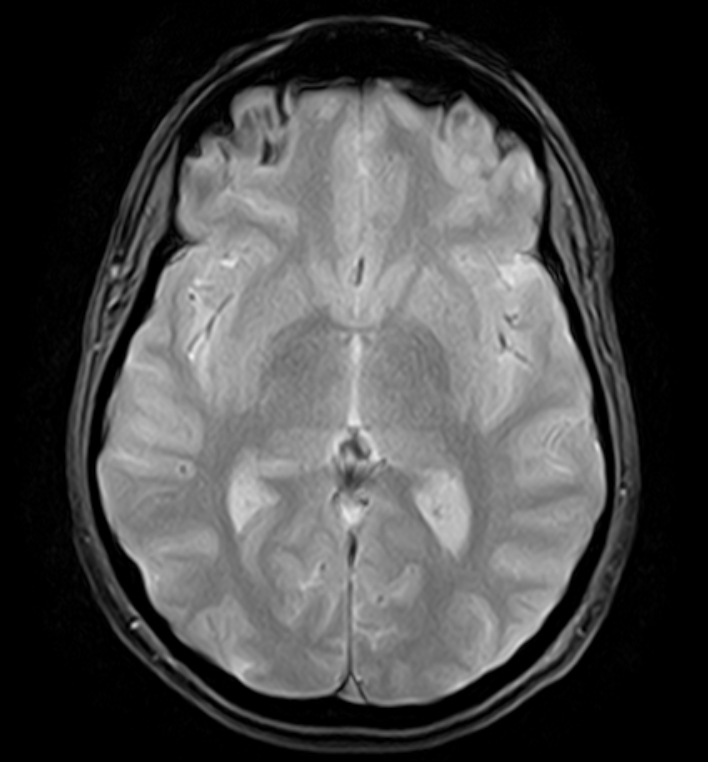 Cavernoma - middle cerebellar peduncle | Image | Radiopaedia.org