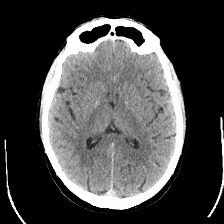 Pituitary macroadenoma with apoplexy | Radiology Case | Radiopaedia.org