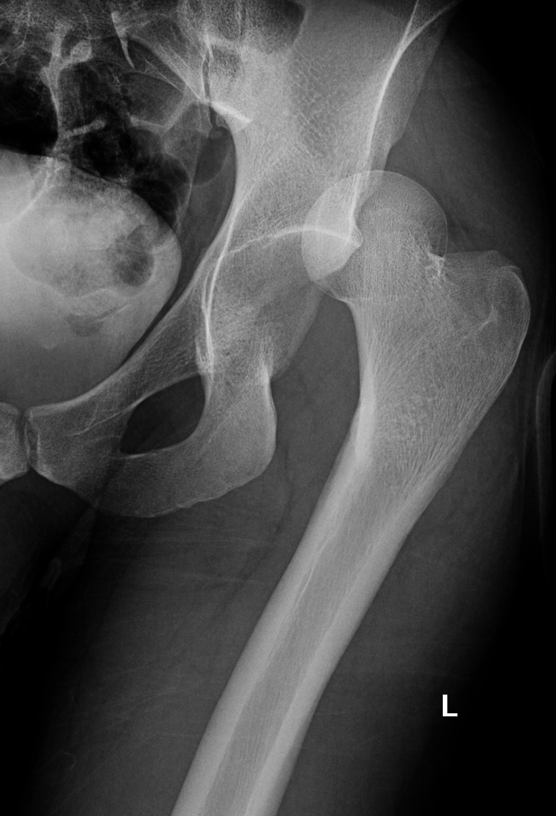 Hip Joint Dislocation Image