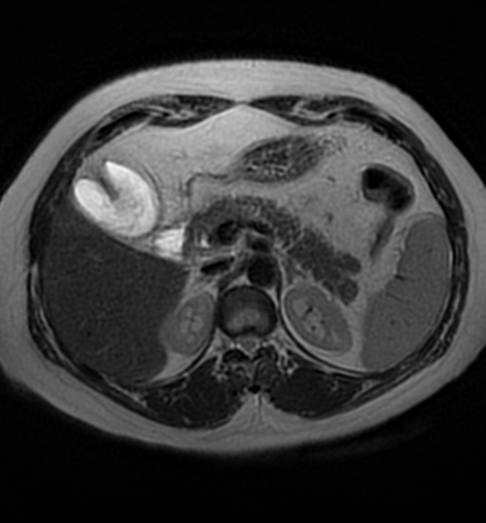 Mucinous adenocarcinoma in gallbladder with fundic duplication | Image ...