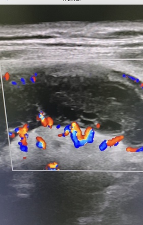 Acute Appendicitis | Radiology Case | Radiopaedia.org