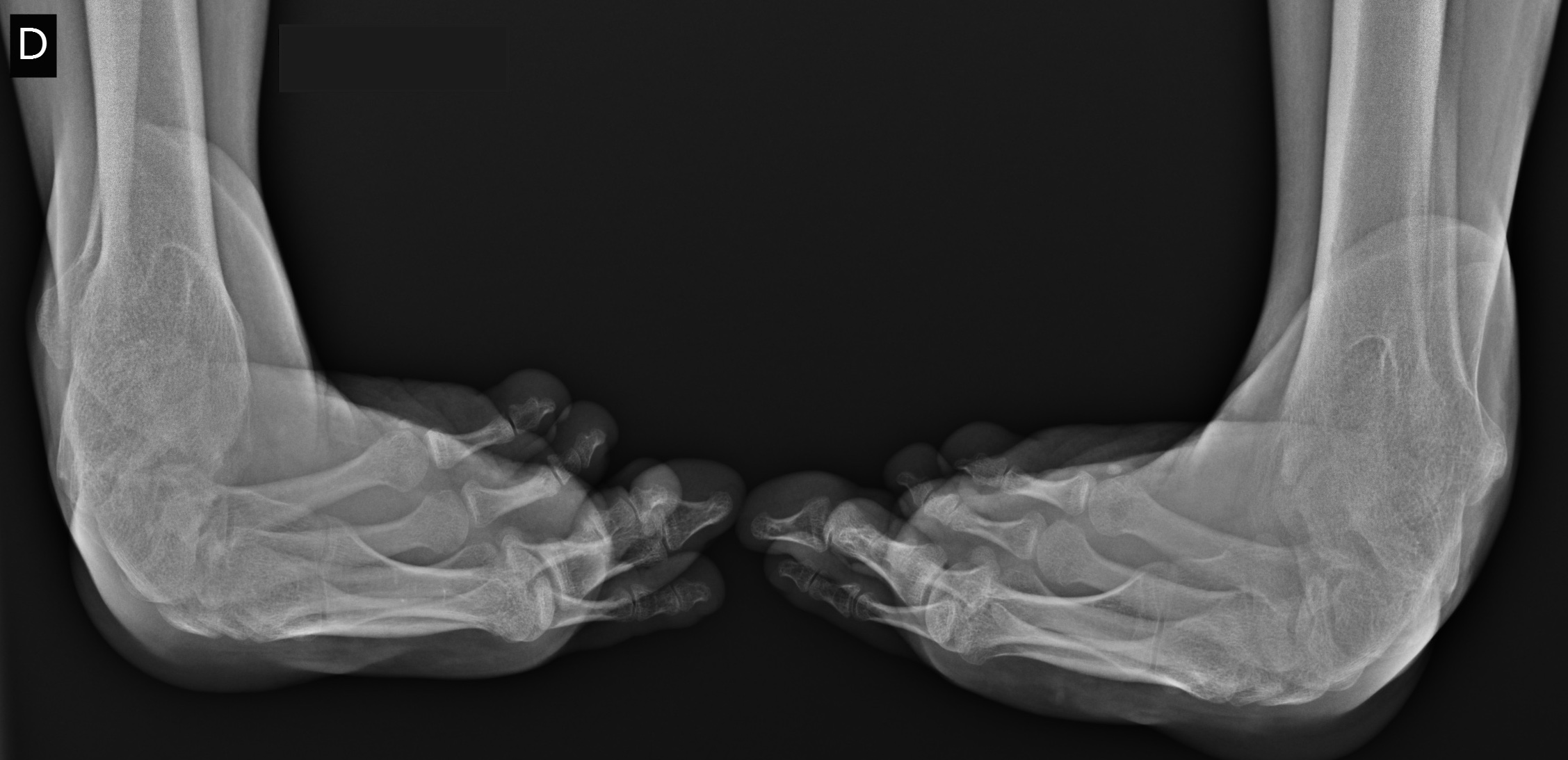 Idiopathic congenital talipes equinovarus in an adult, with follow up