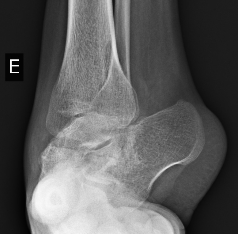 Idiopathic Congenital Talipes Equinovarus In An Adult With Follow Up