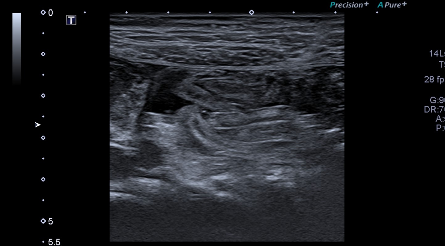 Ascariasis intestinal | Image | Radiopaedia.org