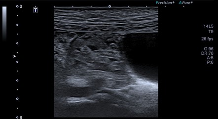 Ascariasis intestinal | Image | Radiopaedia.org