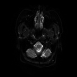 Tuberculous meningitis | Image | Radiopaedia.org