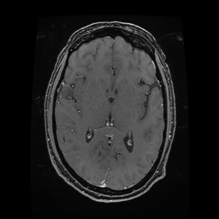 Tuberculous Meningitis | Image | Radiopaedia.org