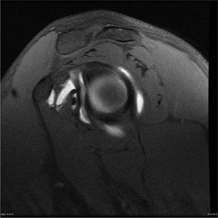 Glenoid Labral Variant Radiology Case Radiopaedia Org