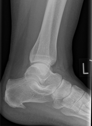 Midtarsal sprain, Radiology Case