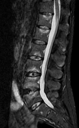 Andersson lesion | Radiology Reference Article | Radiopaedia.org